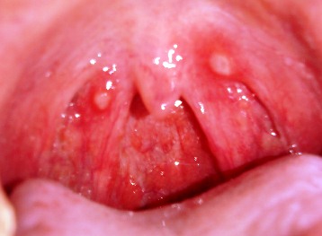 Хронический фарингит у ребенка: найти причину и вылечить навсегда