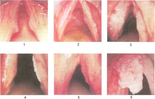 Хронический ларингит у детей: полное руководство для родителей по лечению