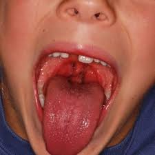 Эпиглоттит у детей: полное руководство для родителей по спасению жизни ребенка