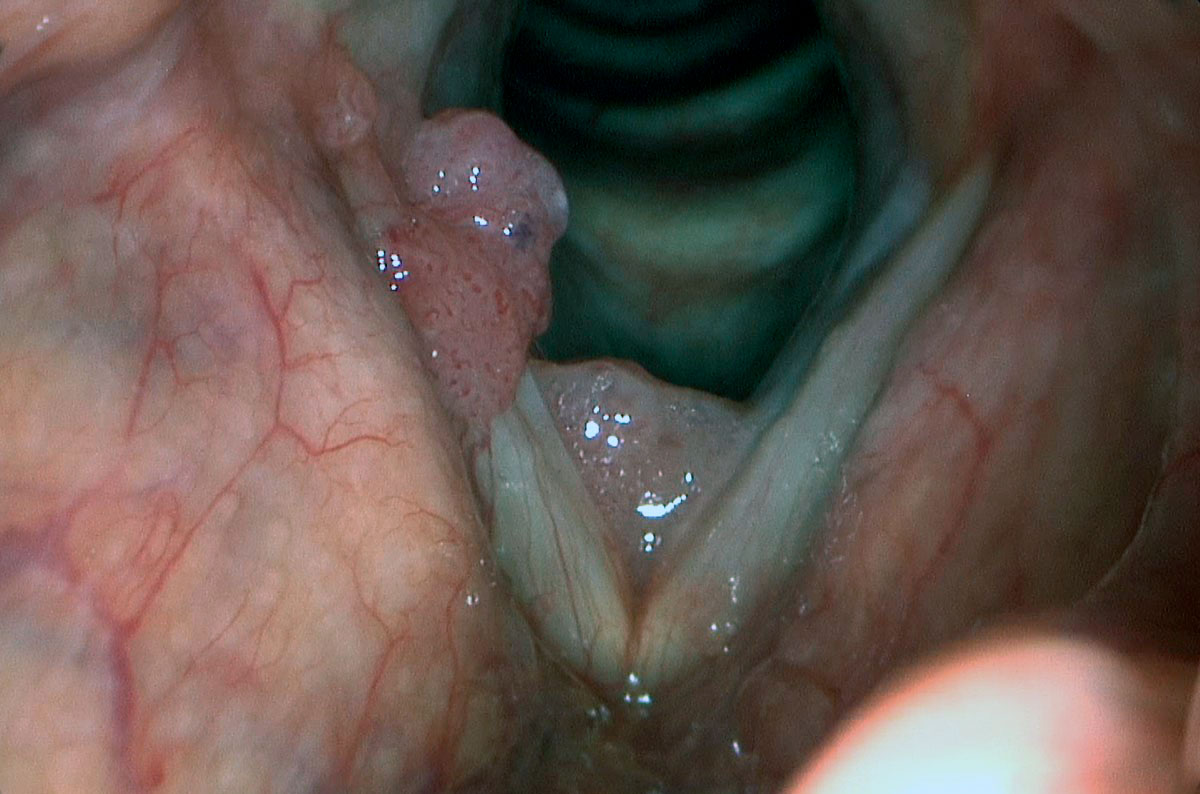 Папилломатоз гортани у детей: полное руководство для родителей по лечению