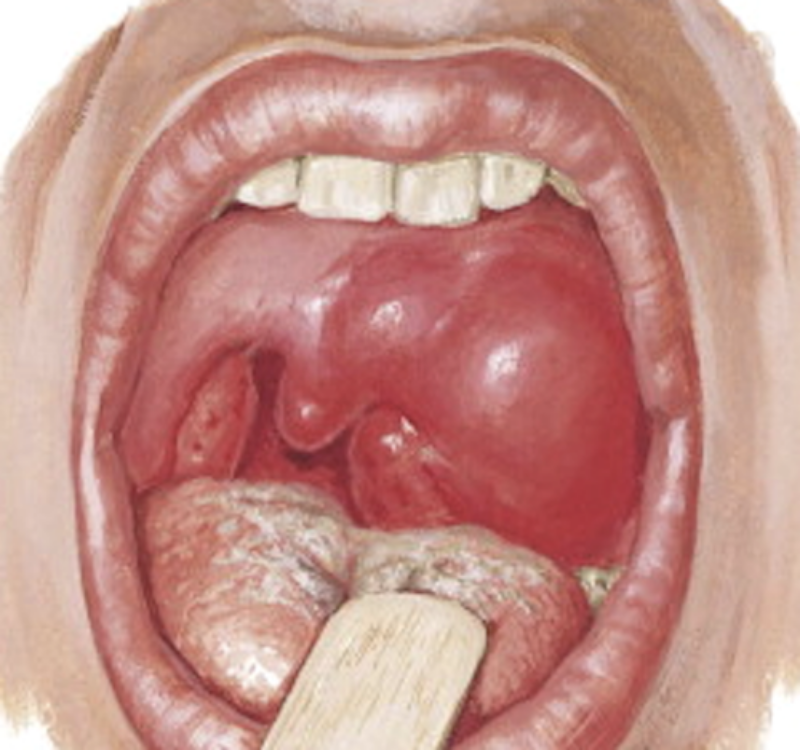 Паратонзиллярный абсцесс у детей: полное руководство для родителей