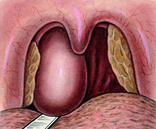 Заглоточный абсцесс у детей: полное руководство для родителей по лечению