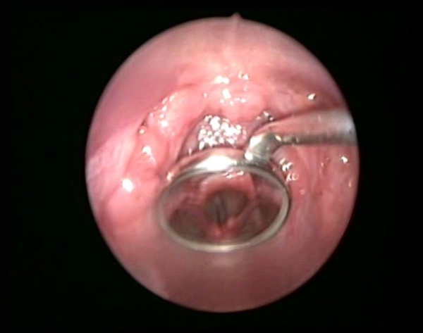 Инородное тело в горле у ребенка: полное руководство для родителей