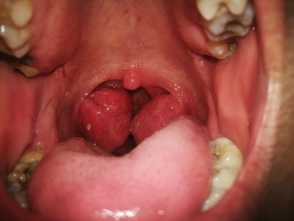 Гипертрофия небных миндалин у детей: когда лечить и как избежать операции