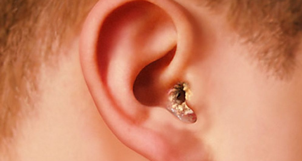 Наружный отит у детей: найти причину и выбрать безопасное лечение