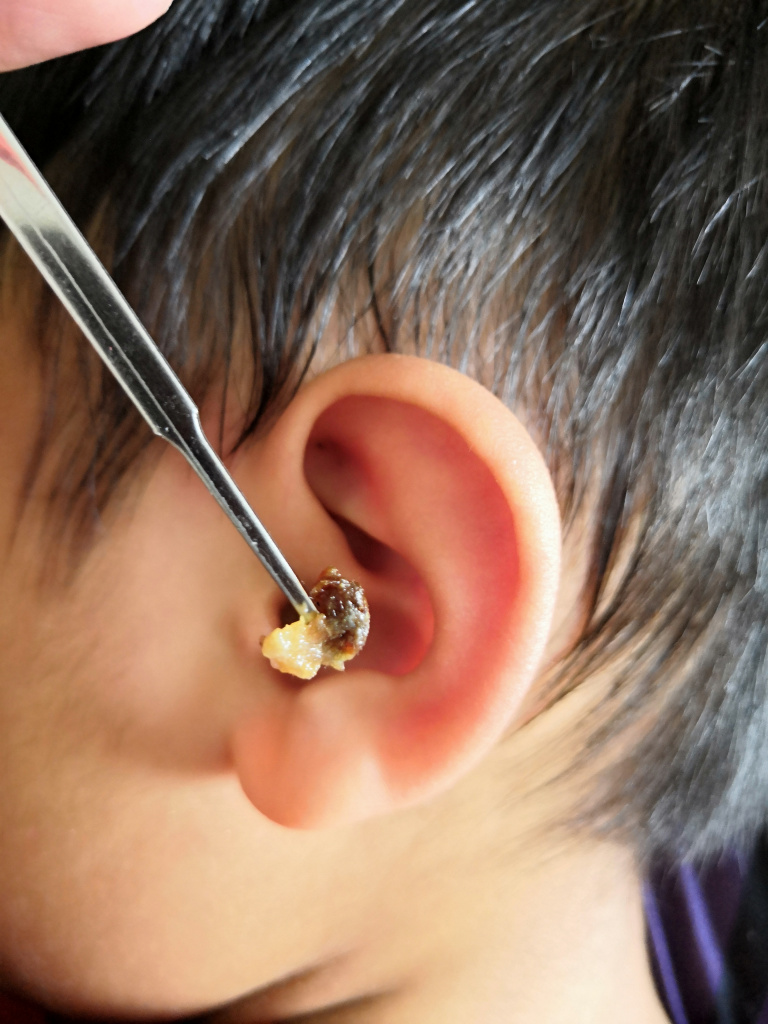 Серная пробка у ребенка: полное руководство по симптомам, причинам и лечению