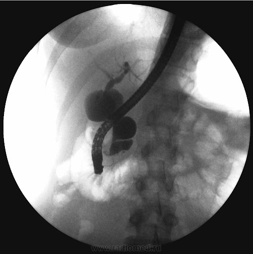 Киста холедоха у детей: от диагноза до полного выздоровления ребенка