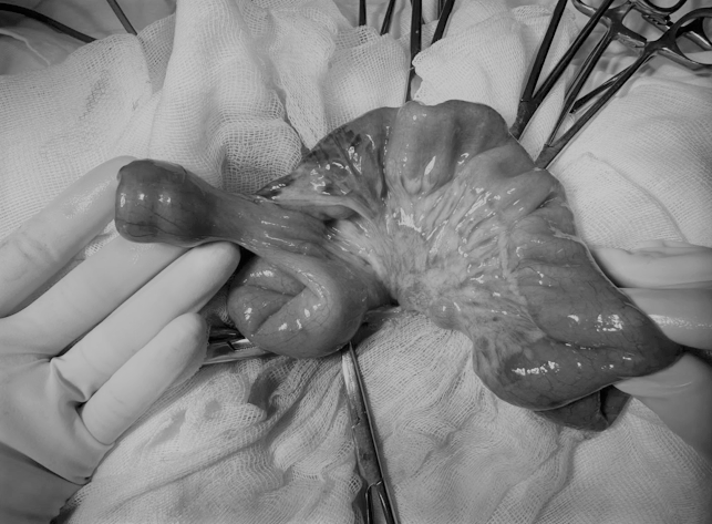 Дивертикул Меккеля у детей: полное руководство для родителей от хирурга