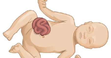 Гастрошизис у новорожденного: от пренатального диагноза до полного выздоровления