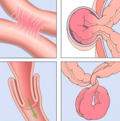 Врожденная кишечная непроходимость у новорожденных: от диагноза к здоровой жизни