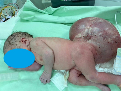 Крестцово-копчиковая тератома у новорожденных: полный гид по лечению