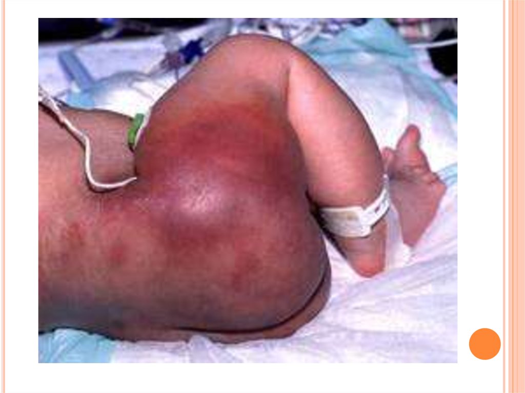 Флегмона новорождённых: полное руководство для родителей по лечению и уходу