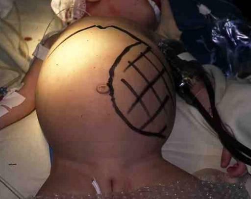 Портальная гипертензия у детей: найти причину и выбрать тактику лечения