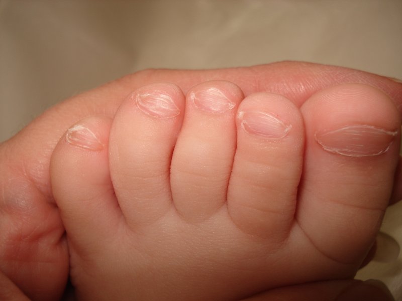 Вросший ноготь у ребенка: полное руководство по лечению от детского хирурга