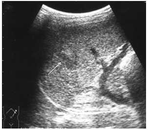 Травма селезенки у ребенка: полное руководство для родителей по лечению
