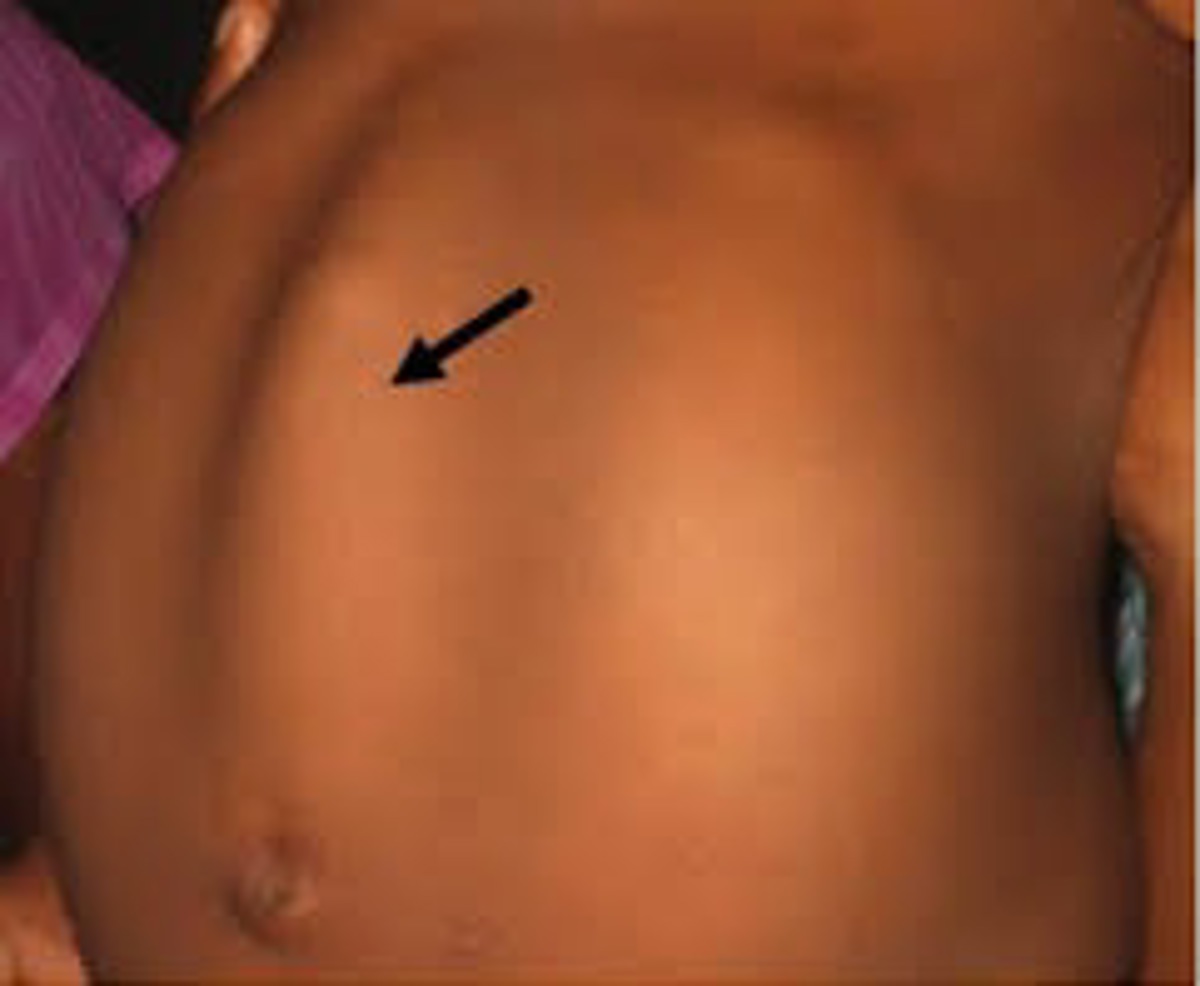 Грыжа белой линии живота у ребенка: полное руководство для родителей по лечению