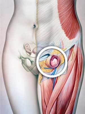 Бедренная грыжа у детей: полное руководство для родителей от хирурга