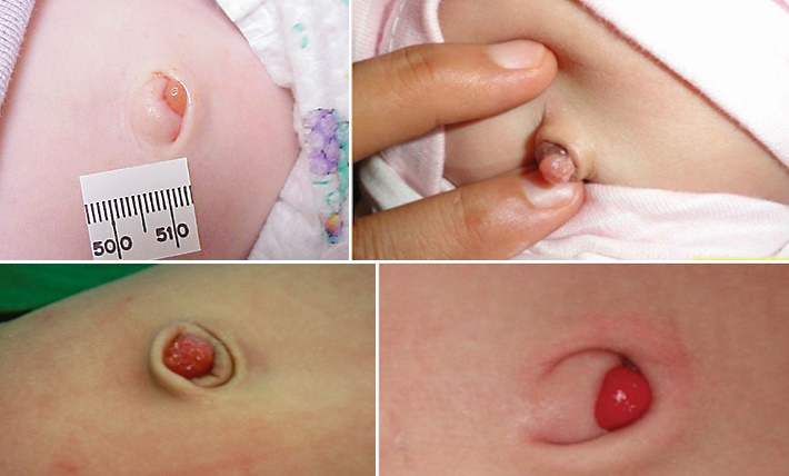 Фунгус пупка у новорожденных: полное руководство по лечению и уходу