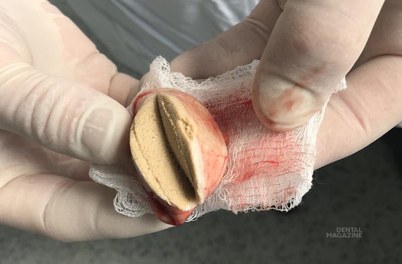 Дермоидная киста у ребенка: полное руководство по диагностике и лечению