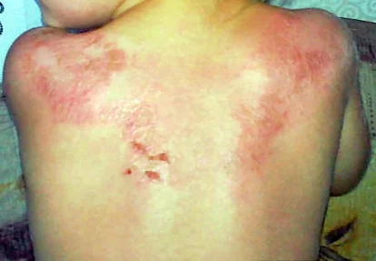 Ожоги у детей: полное руководство для родителей по видам, помощи и лечению