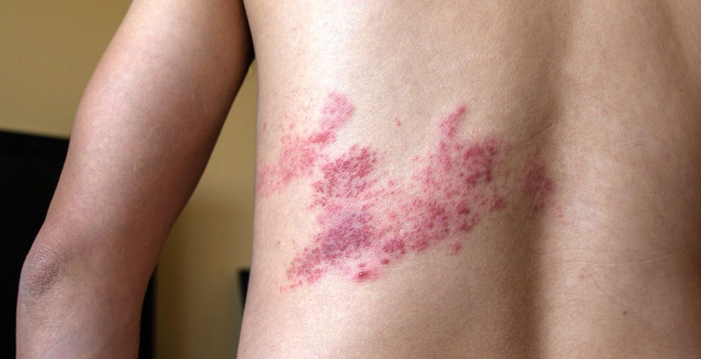 Опоясывающий герпес: полное руководство по симптомам, лечению и профилактике