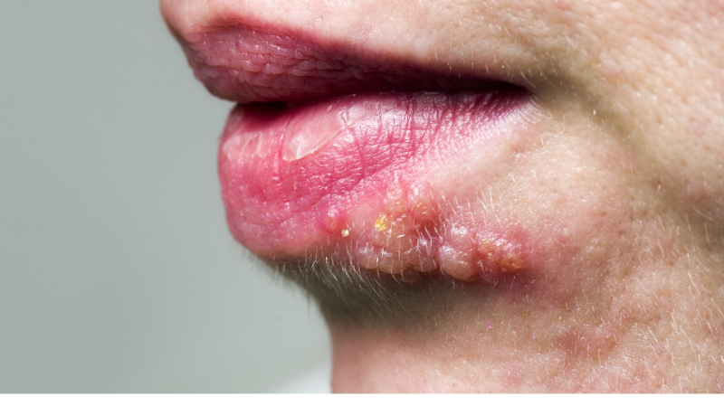 Простой герпес: полное руководство по диагностике, лечению и профилактике