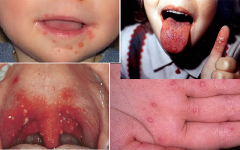 Энтеровирусная инфекция: полное руководство по симптомам, лечению и защите