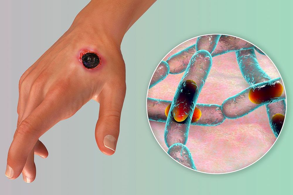 Сибирская язва: полное руководство по симптомам, лечению и защите