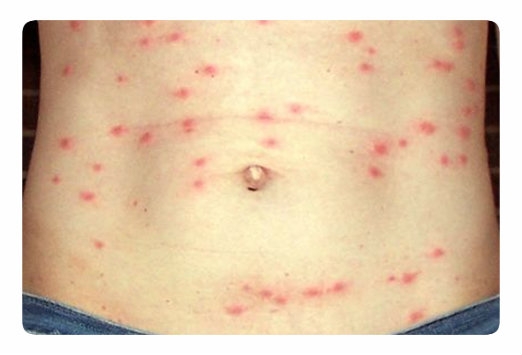 Брюшной тиф: полное руководство по симптомам, лечению и профилактике