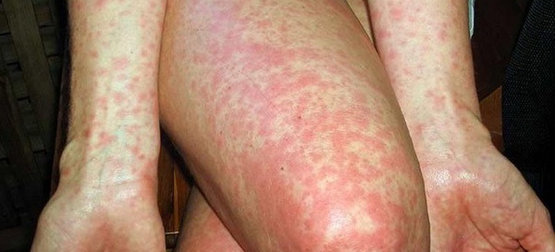 Иерсиниоз: полное руководство по заболеванию от причин до восстановления