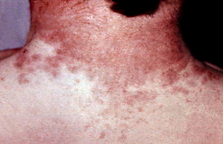 Псевдотуберкулез: полное руководство по симптомам, лечению и профилактике