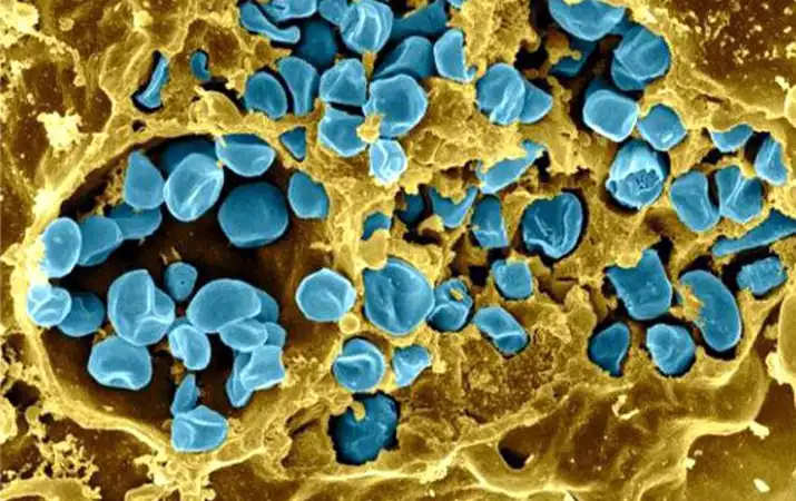 Туляремия: полное руководство по симптомам, лечению и профилактике болезни