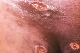 Мягкий шанкр: полное руководство по симптомам, лечению и профилактике