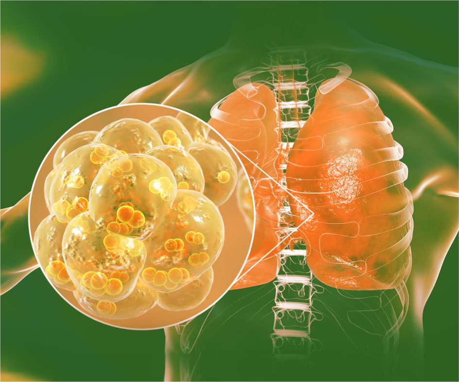 Пневмококковая инфекция: полное руководство по защите, диагностике и лечению
