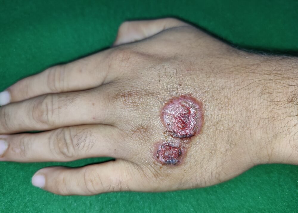 Лейшманиоз: полное руководство по симптомам, лечению и защите от болезни