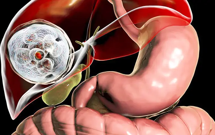 Эхинококкоз: полное руководство по диагностике, лечению и профилактике