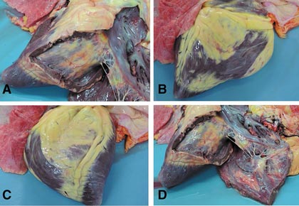 Аритмогенная дисплазия правого желудочка: полное руководство по заболеванию