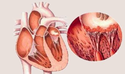 Миокардит: полное руководство по лечению и восстановлению здоровья сердца