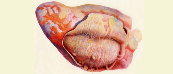 Перикардит: полное руководство по причинам, симптомам и лечению воспаления сердца
