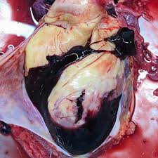 Тампонада сердца: полное руководство по причинам, симптомам и лечению