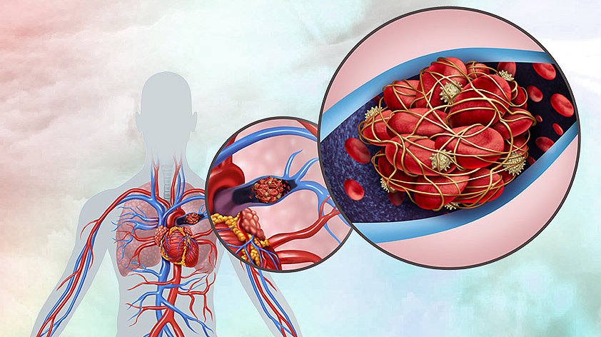 Тромбоэмболия легочной артерии (ТЭЛА): полное руководство по заболеванию