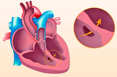 Дефект межпредсердной перегородки: обрести здоровье сердца на всю жизнь