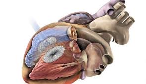 Дефект межжелудочковой перегородки: обрести уверенность в диагнозе и лечении