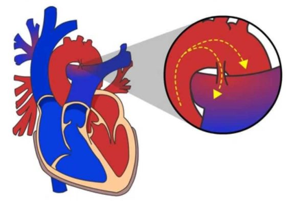 Открытый артериальный проток: полное руководство по диагностике и лечению