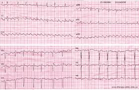 Трепетание предсердий: полное руководство по симптомам, лечению и прогнозу