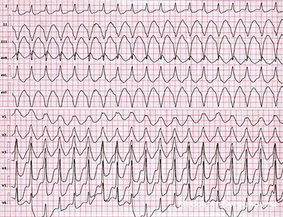 Желудочковая тахикардия: полное руководство по причинам, симптомам и лечению