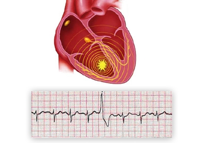 Желудочковая экстрасистолия: полное руководство по причинам и лечению аритмии