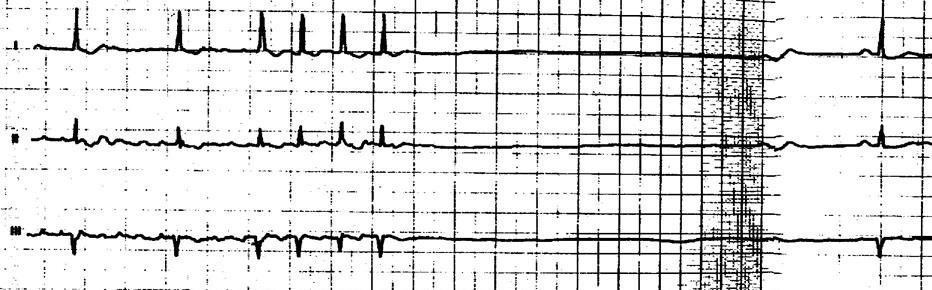Синдром слабости синусового узла: полное руководство по диагностике и лечению