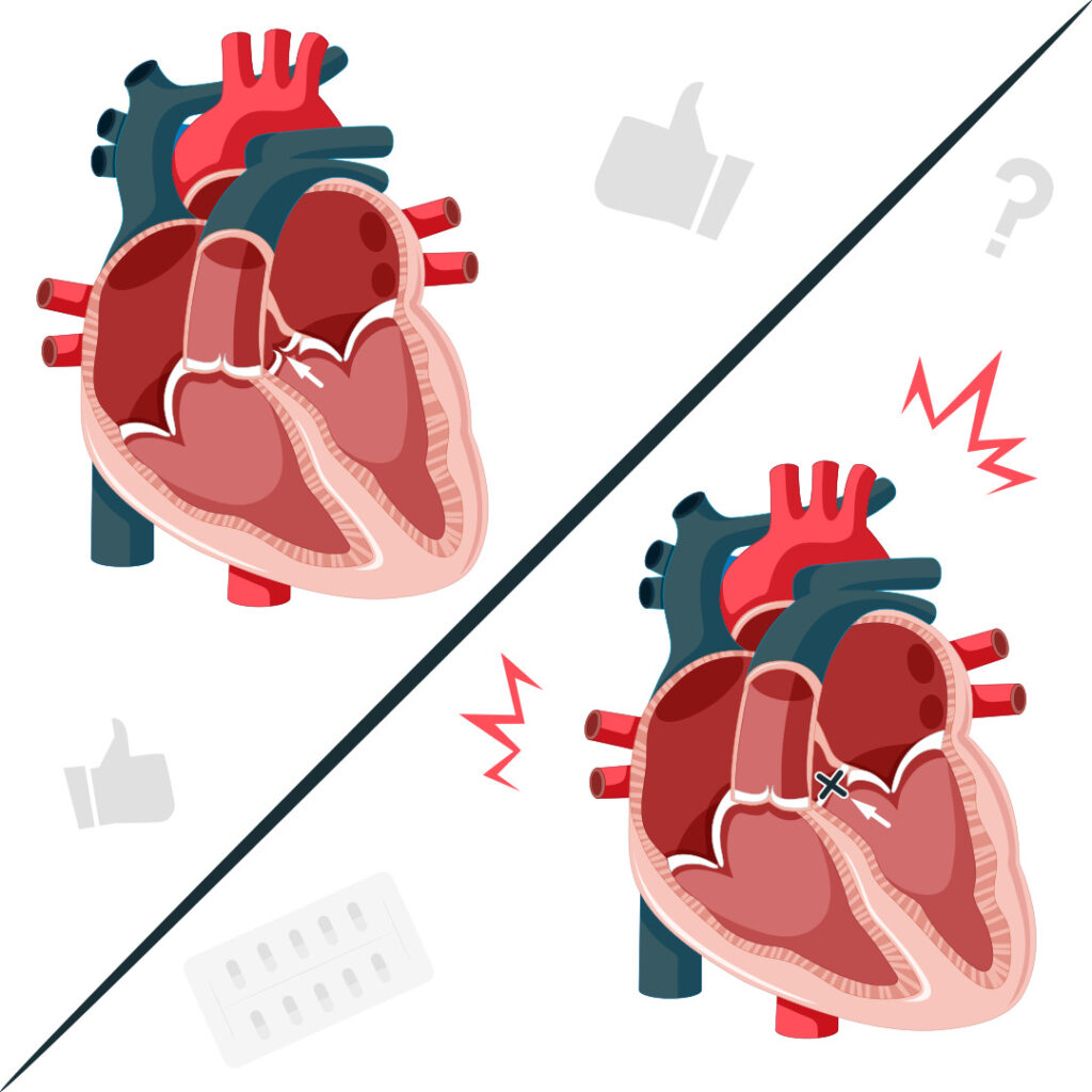 Атриовентрикулярная блокада сердца: от причин до жизни с кардиостимулятором
