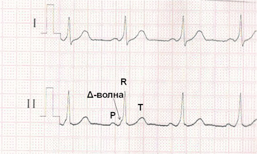 Понимание синдрома Вольфа-Паркинсона-Уайта (WPW) и управление рисками